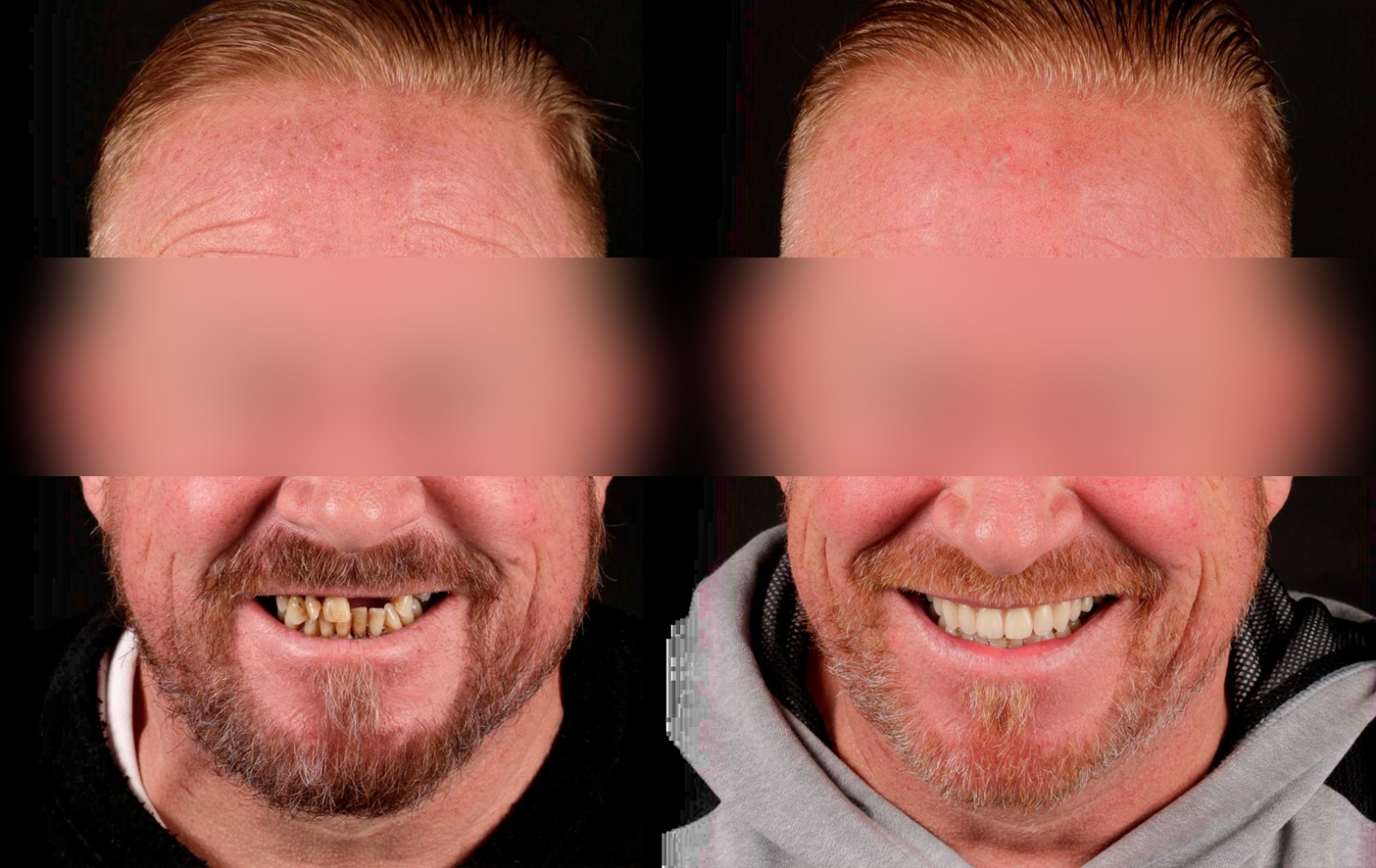 Fotografías de antes y después, de paciente que ha recibido tratamiento de:Periodontics + Rehabilitation