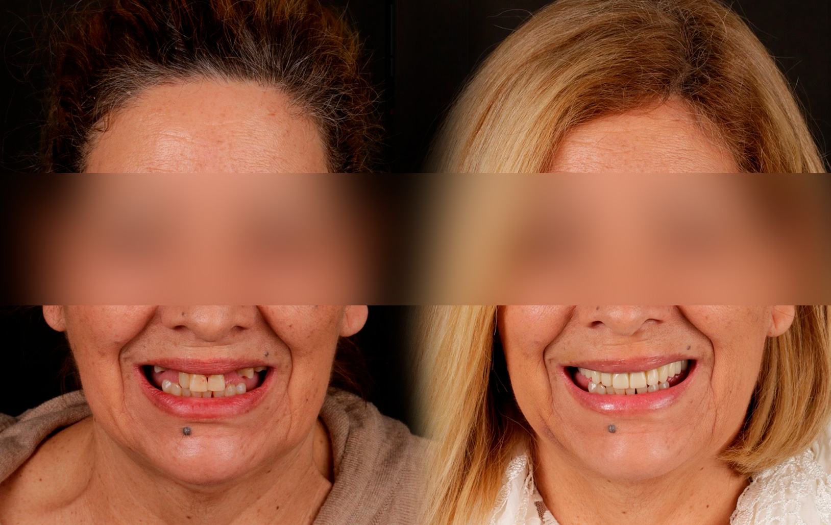Fotografías de antes y después, de paciente que ha recibido tratamiento de:Oral Rejuvenation + Guided Surgery