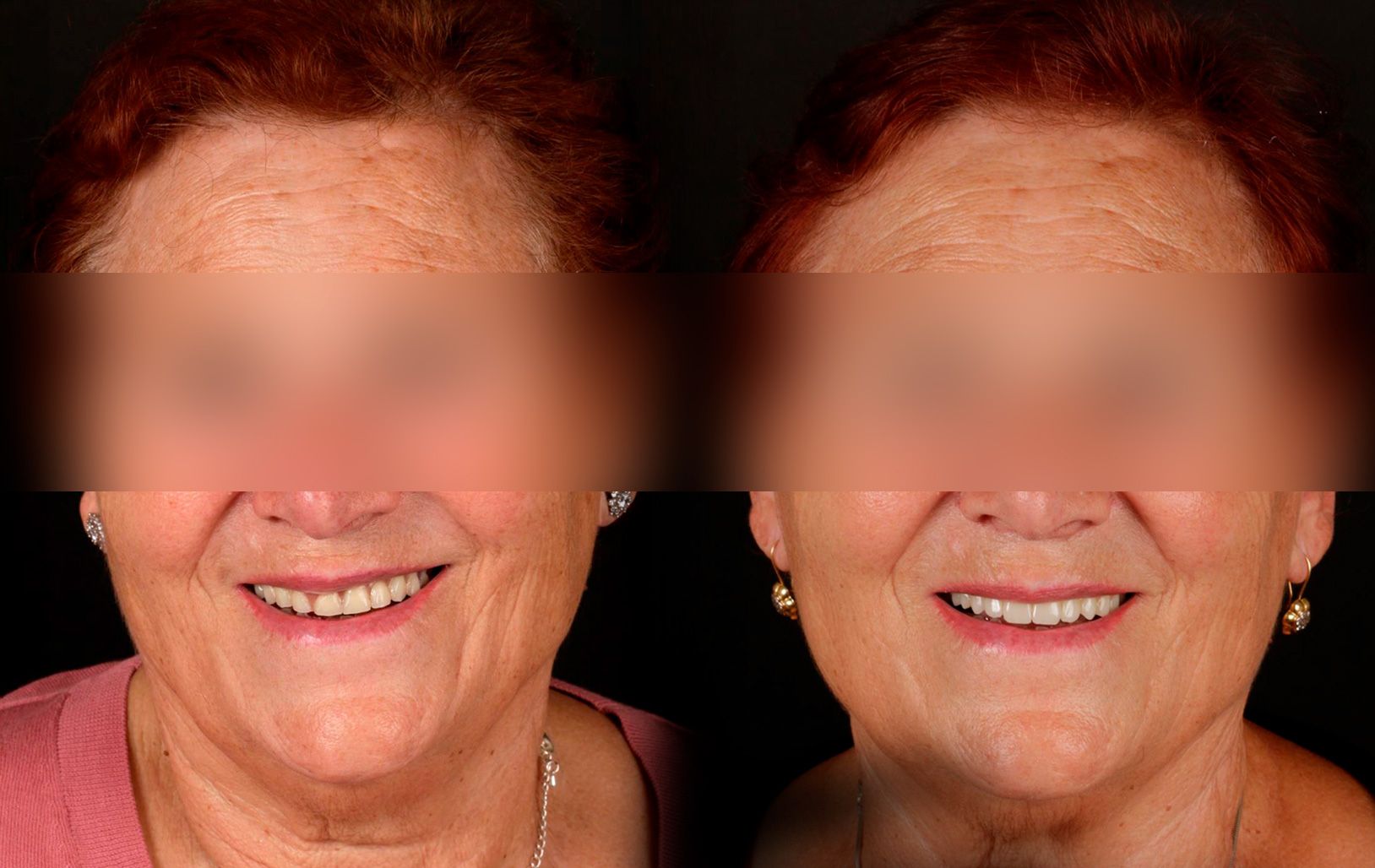 Fotografías de antes y después, de paciente que ha recibido tratamiento de:Oral Rejuvenation + Guided Surgery