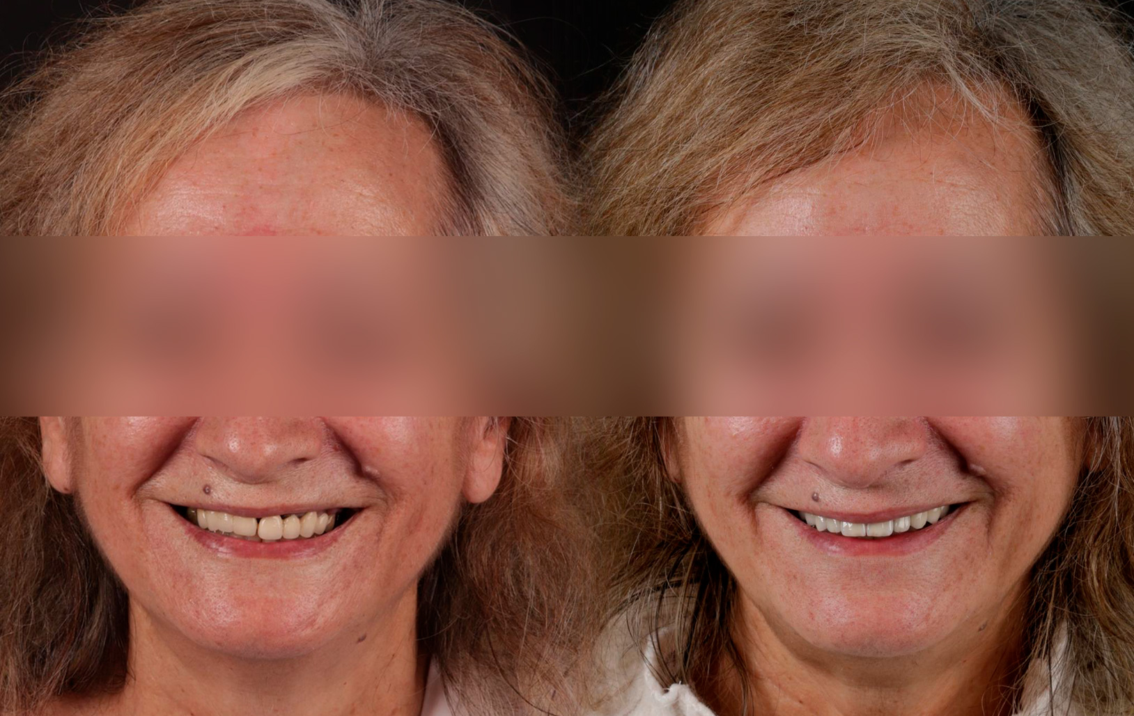 Fotografías de antes y después, de paciente que ha recibido tratamiento de:Oral Rejuvenation + Guided Surgery