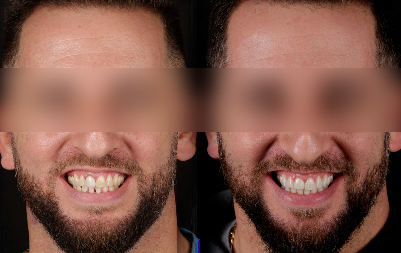 Fotografías de antes y después, de paciente que ha recibido tratamiento de:Whitening + Crown Replacement