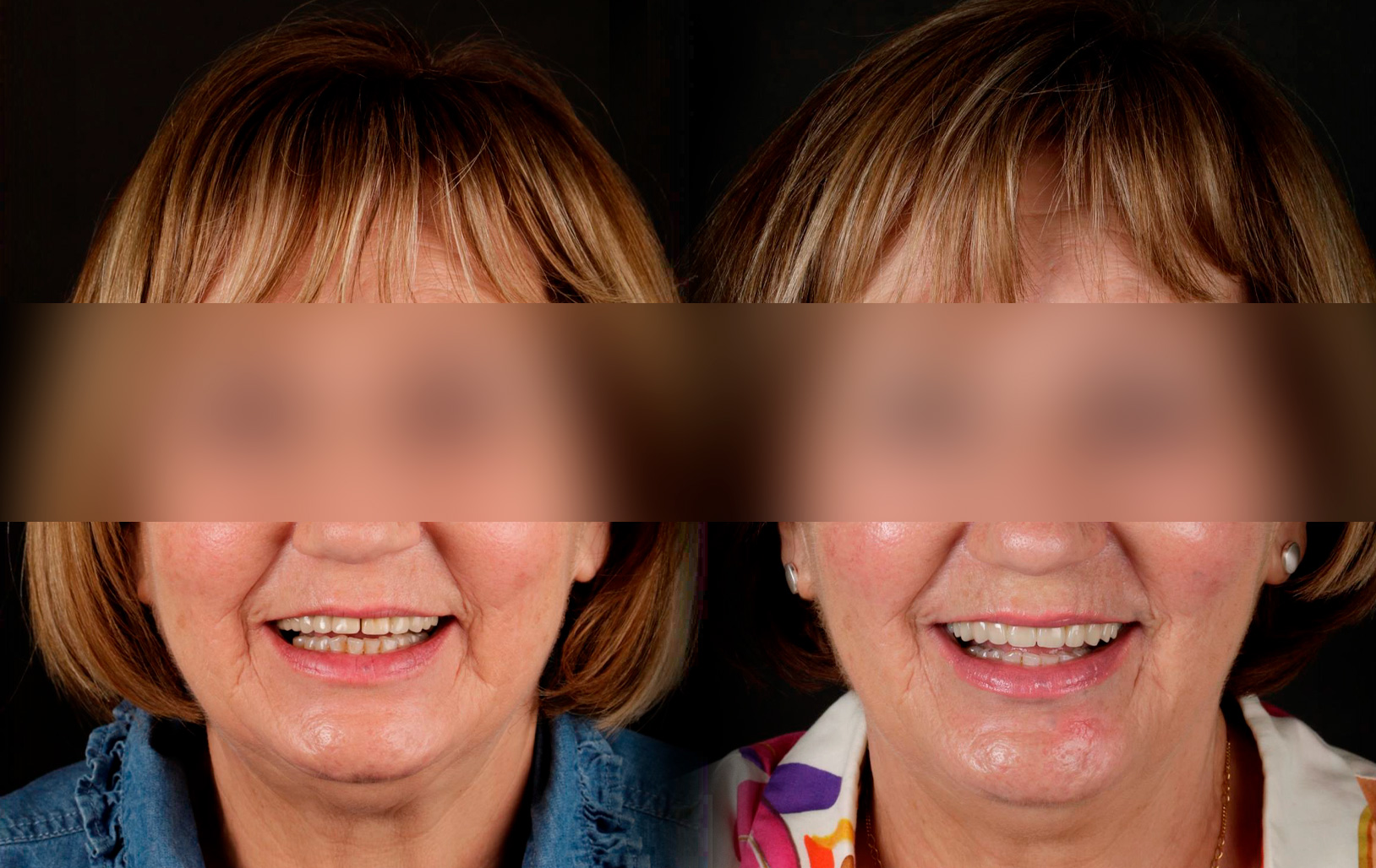 Fotografías de antes y después, de paciente que ha recibido tratamiento de:Oral Rejuvenation + Guided Surgery