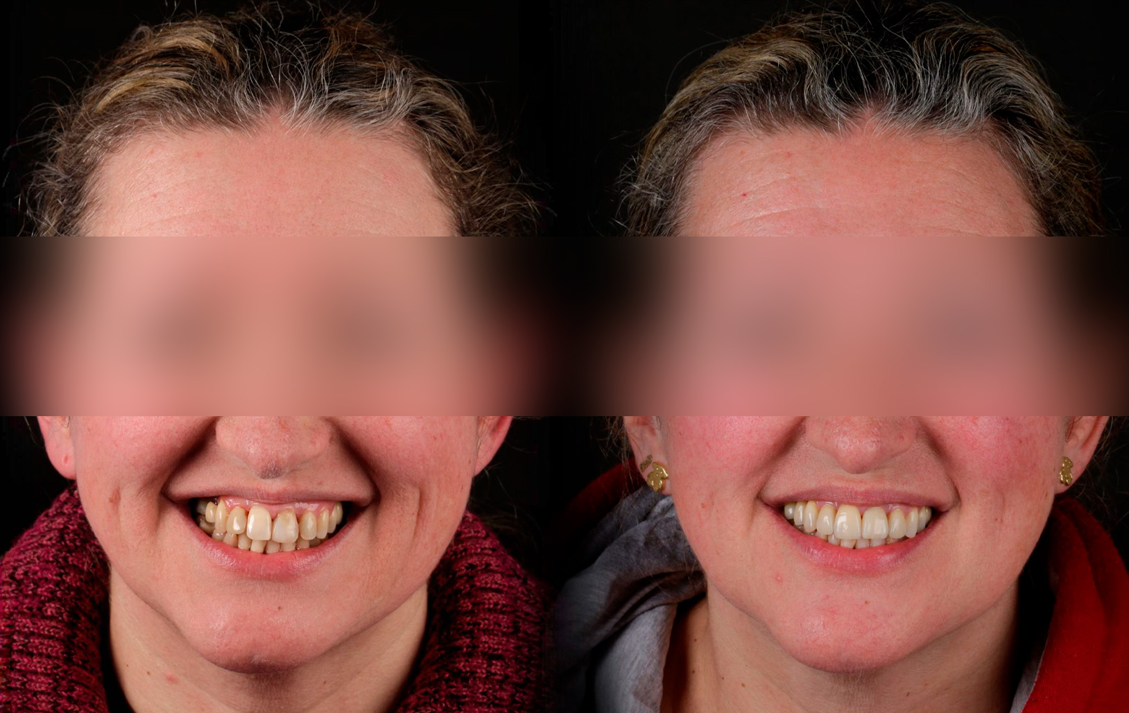 Fotografías de antes y después, de paciente que ha recibido tratamiento de:Periodontics + Whitening + Veneers