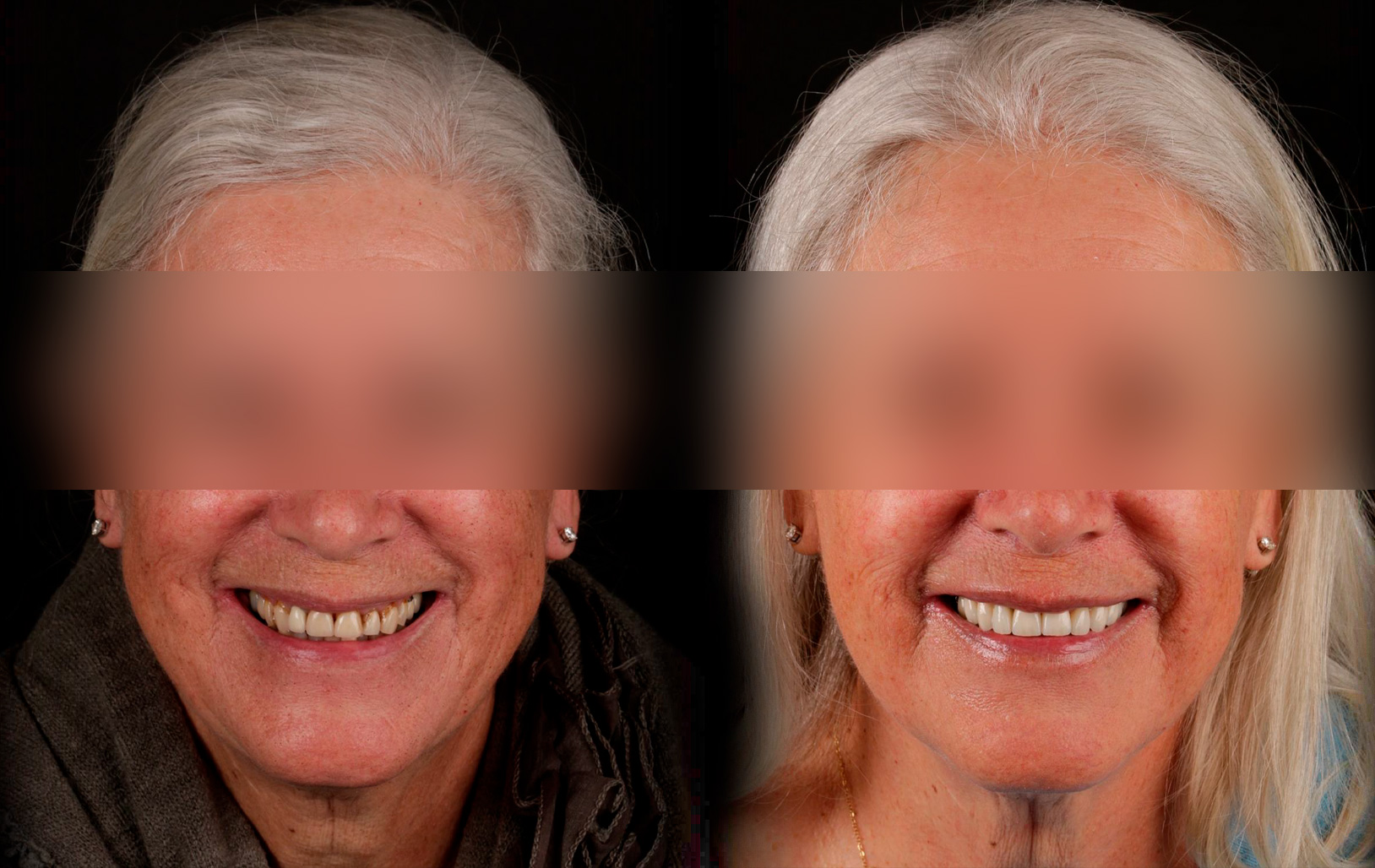 Fotografías de antes y después, de paciente que ha recibido tratamiento de:Oral Rejuvenation + Veneers