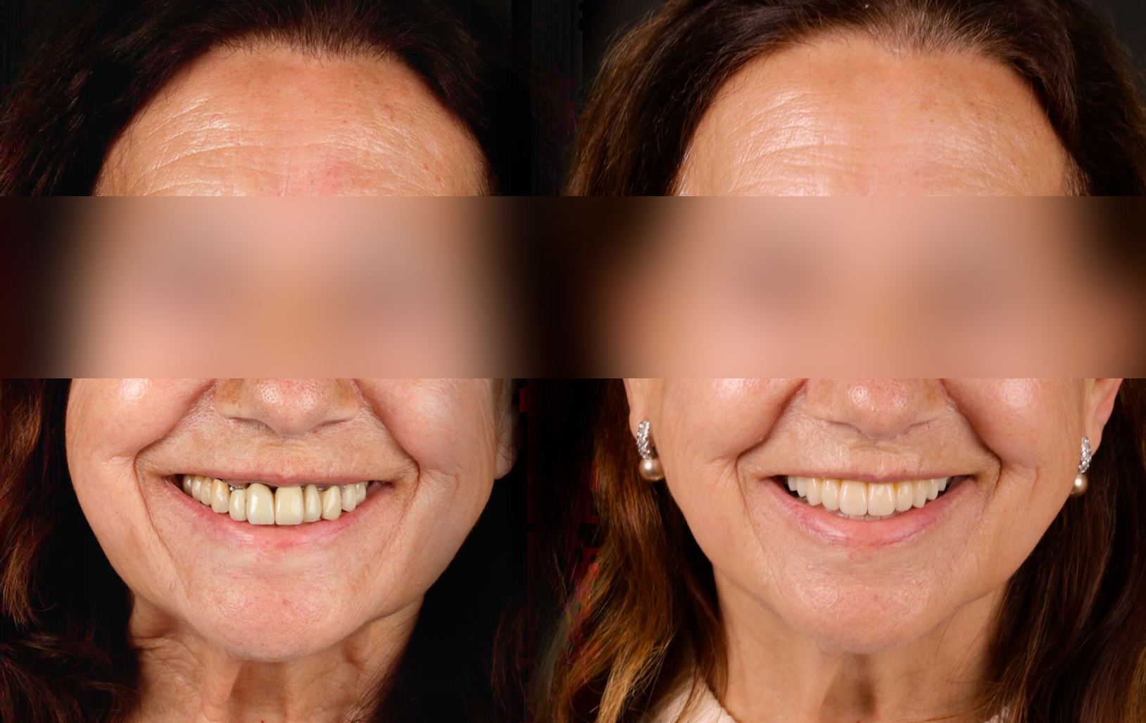 Fotografías de antes y después, de paciente que ha recibido tratamiento de:Periodontal Treatment + Implant Rehabilitation