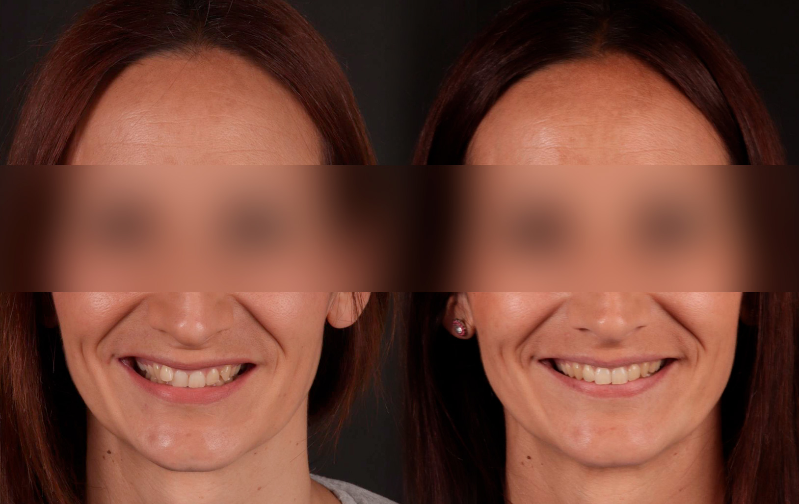 Fotografías de antes y después, de paciente que ha recibido tratamiento de:Invisalign