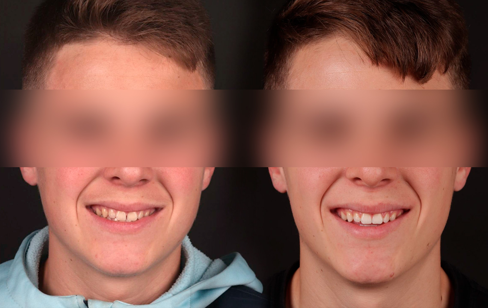 Fotografías de antes y después, de paciente que ha recibido tratamiento de:Invisalign