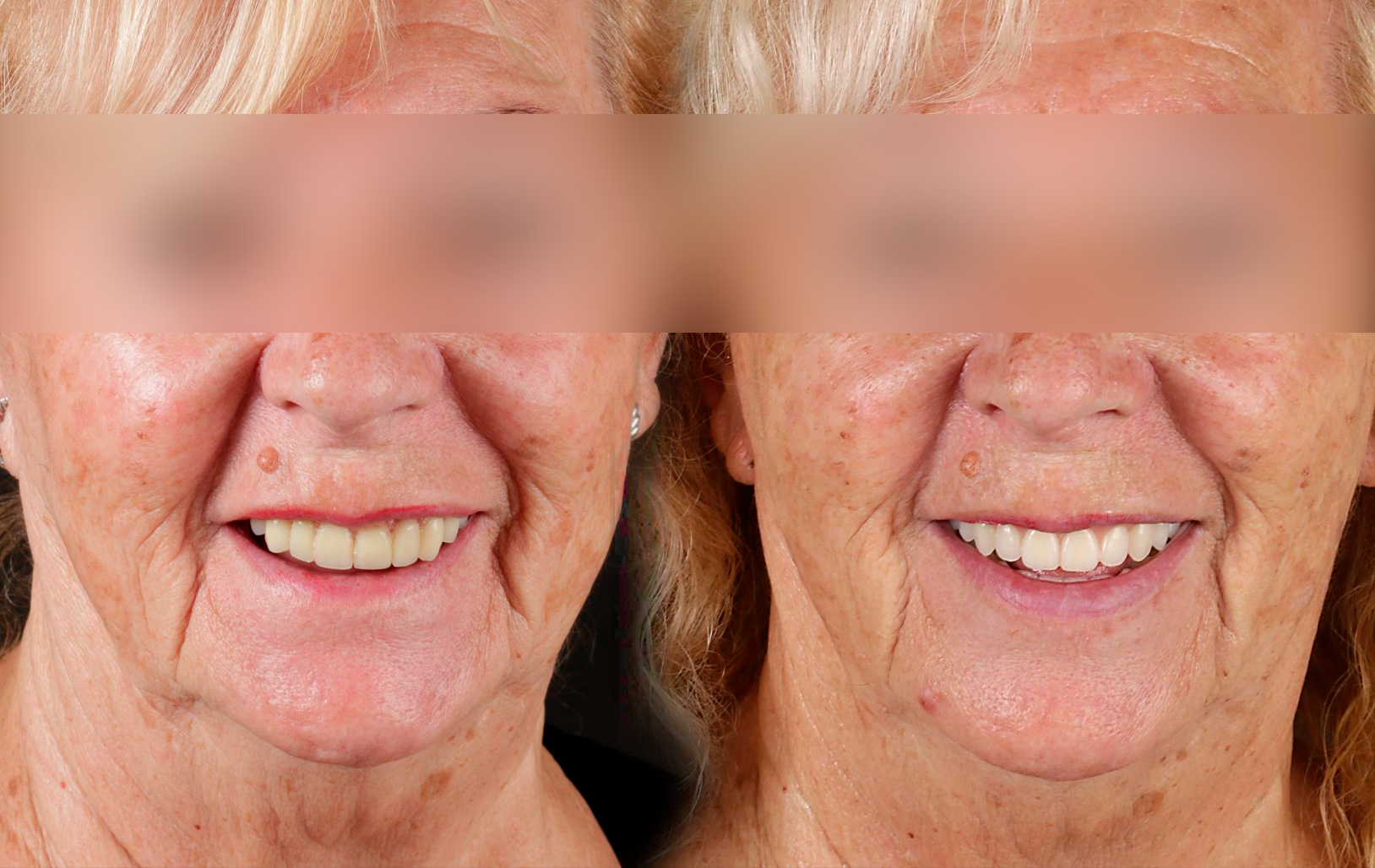 Fotografías de antes y después, de paciente que ha recibido tratamiento de:Oral Rejuvenation