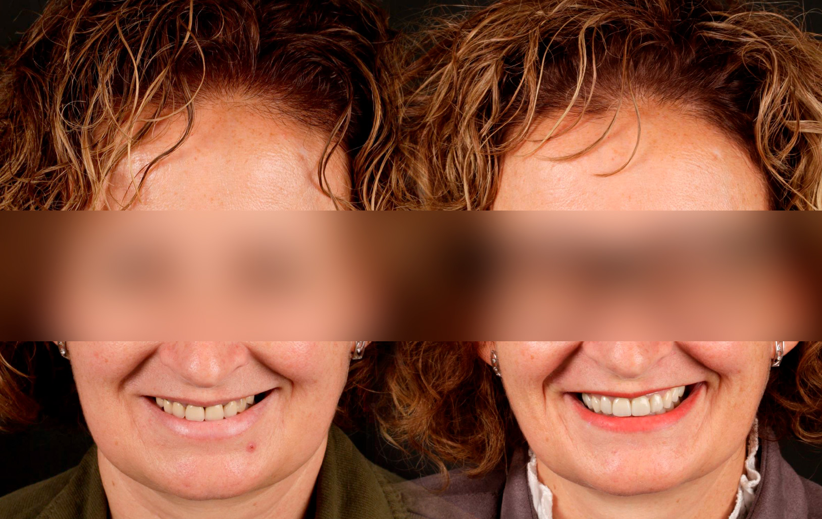 Fotografías de antes y después, de paciente que ha recibido tratamiento de:Oral Rehabilitation