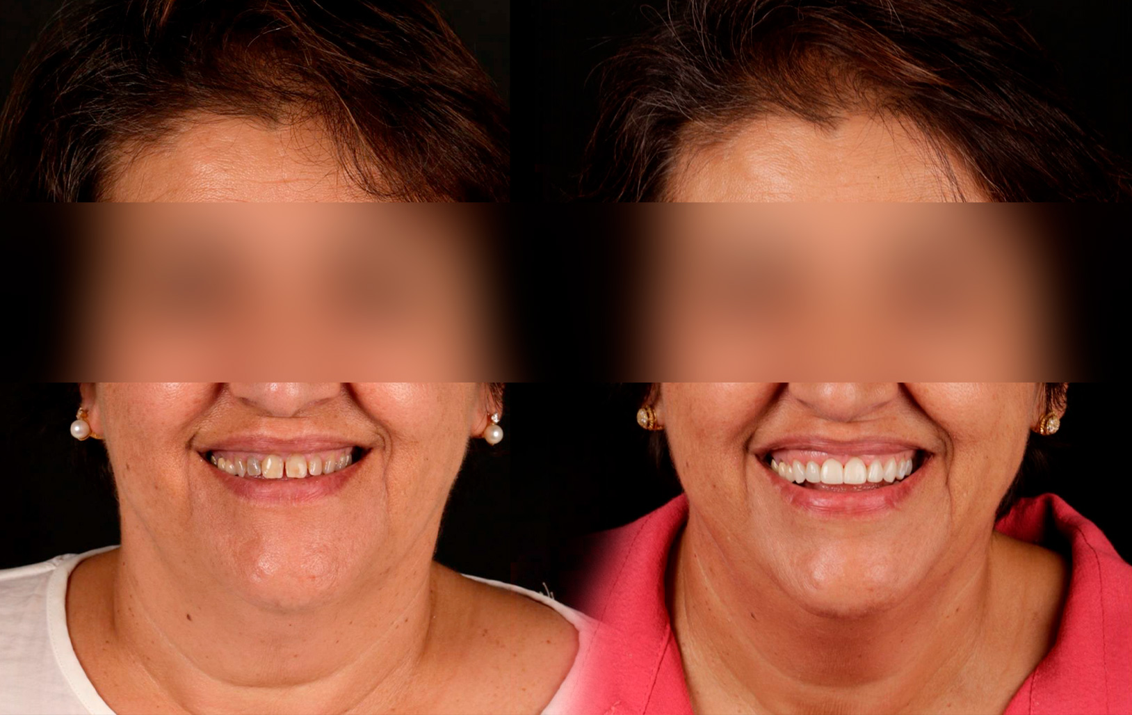 Fotografías de antes y después, de paciente que ha recibido tratamiento de:Whitening + Veneers + Tetracyclines