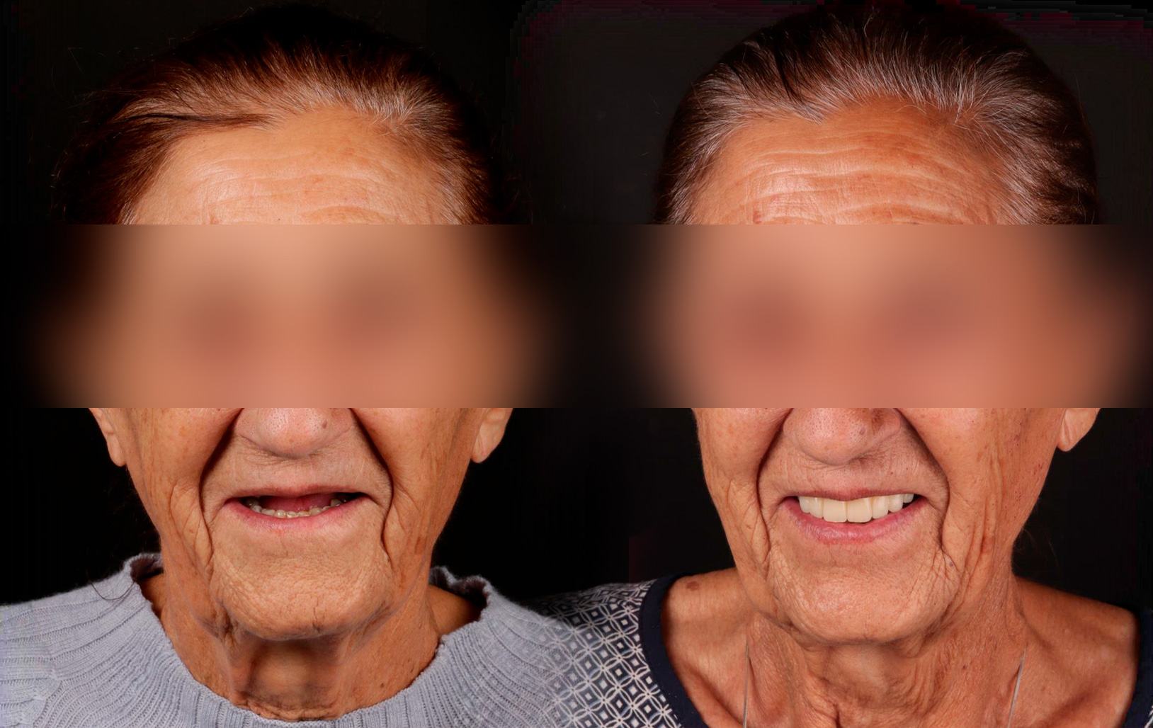 Fotografías de antes y después, de paciente que ha recibido tratamiento de:Oral Rejuvenation + Guided Surgery