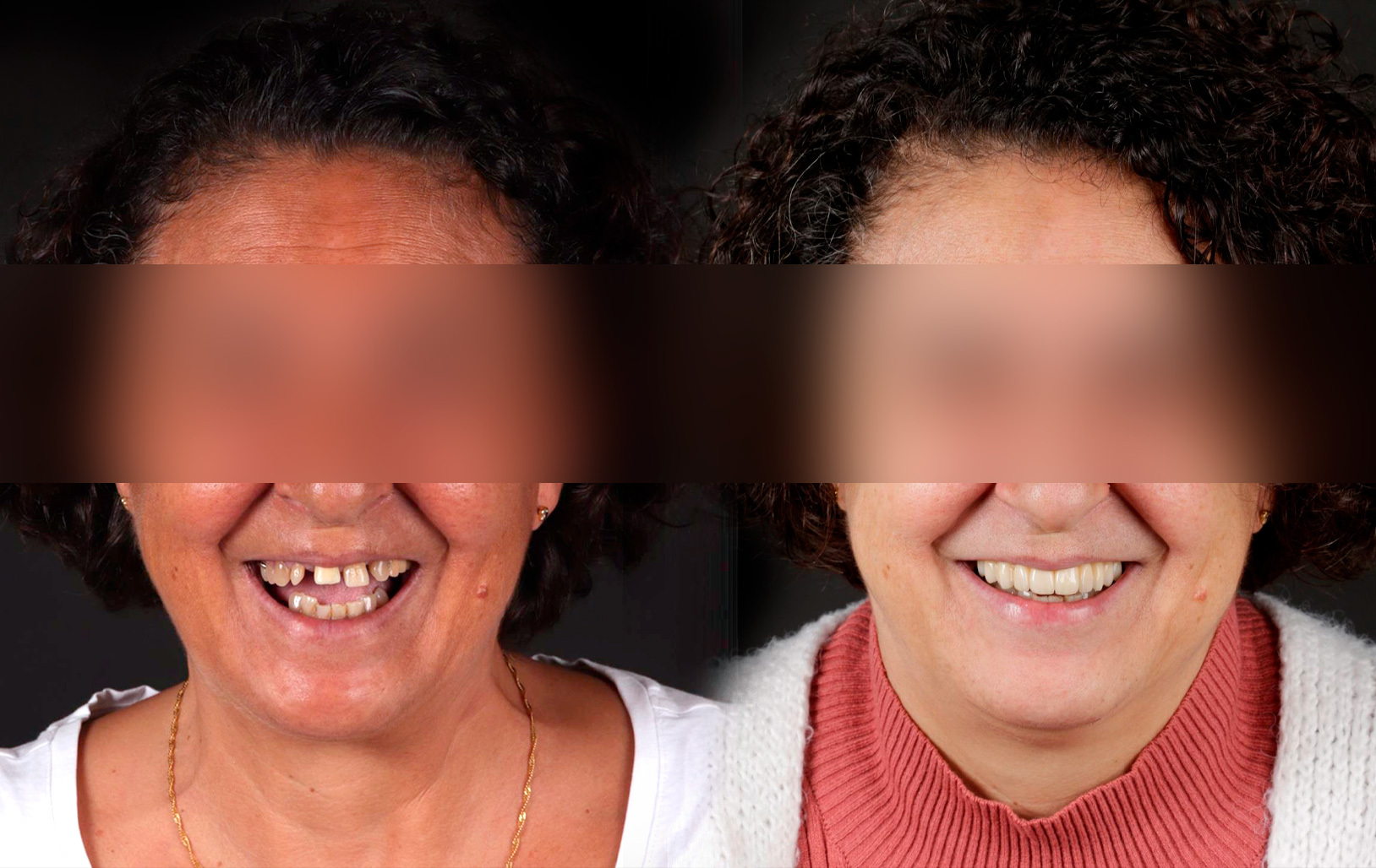 Fotografías de antes y después, de paciente que ha recibido tratamiento de:Oral Rehabilitation + Guided Surgery
