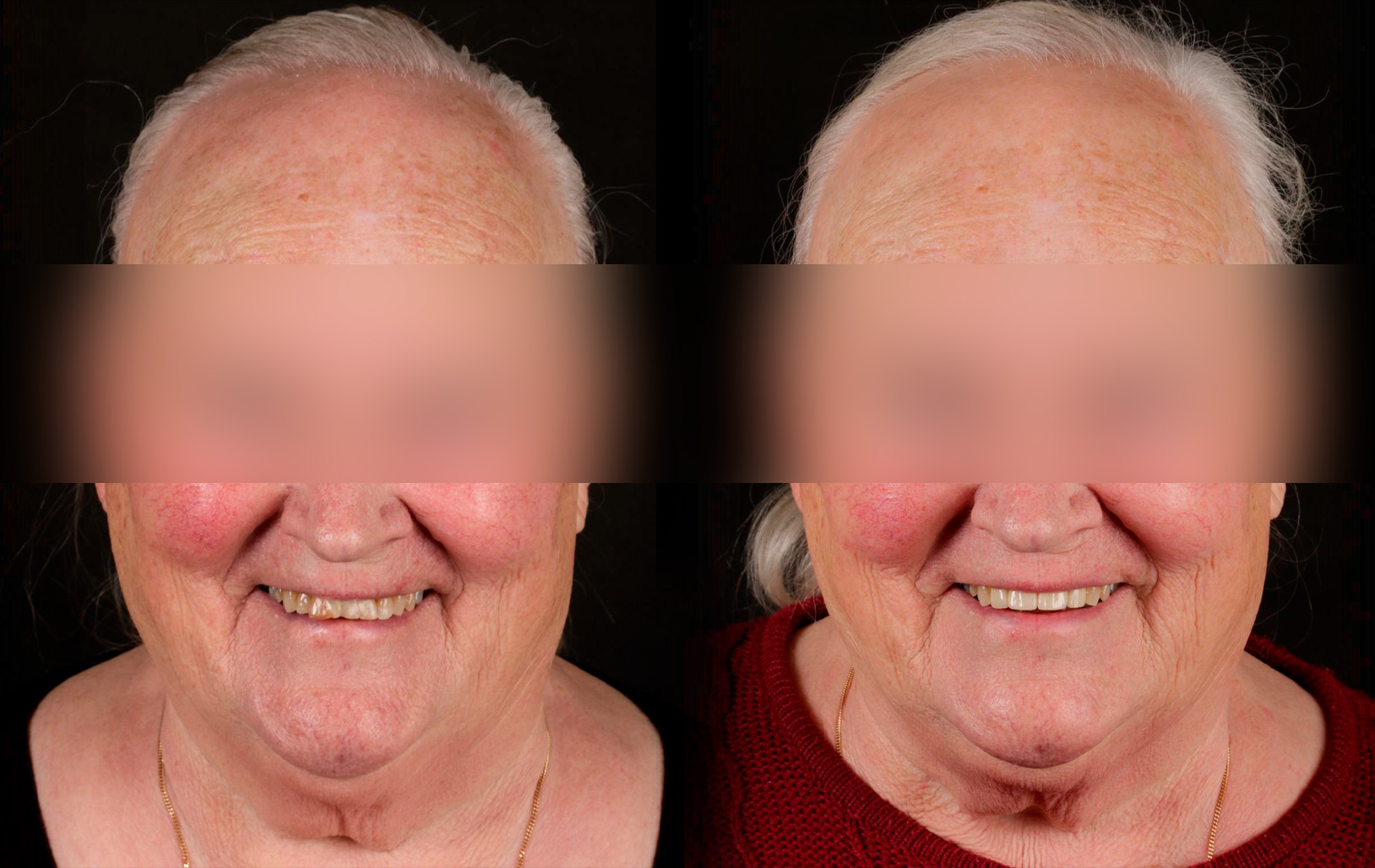 Fotografías de antes y después, de paciente que ha recibido tratamiento de:Oral Rehabilitation + Crowns
