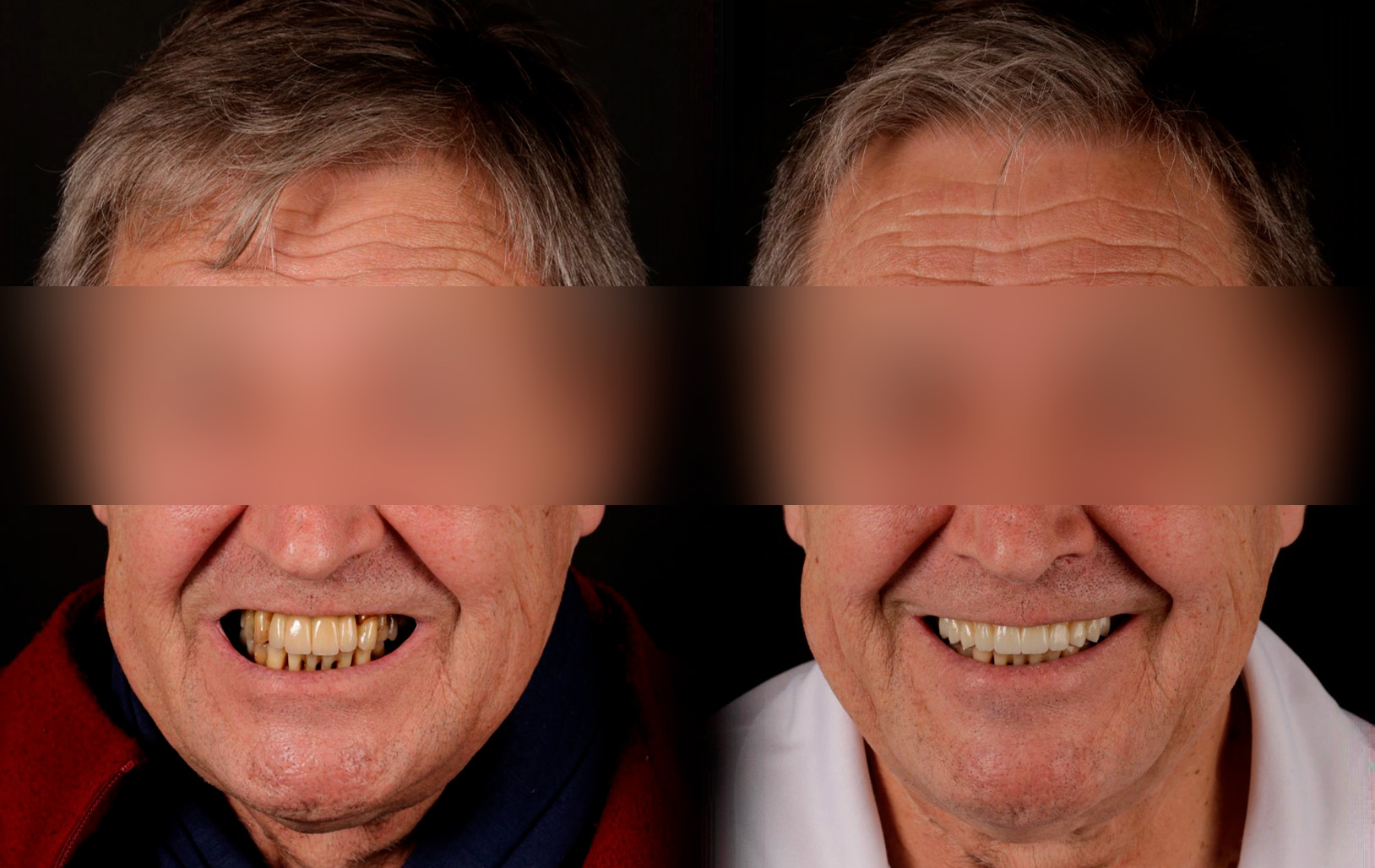 Fotografías de antes y después, de paciente que ha recibido tratamiento de:Oral Rejuvenation + Guided Surgery