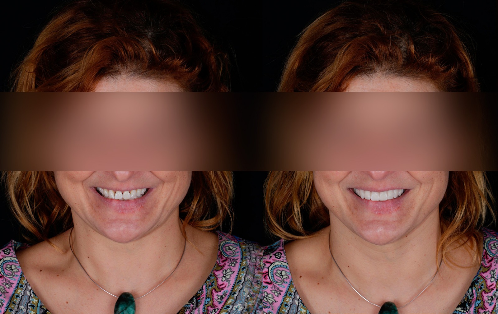 Fotografías de antes y después, de paciente que ha recibido tratamiento de:Smile Design