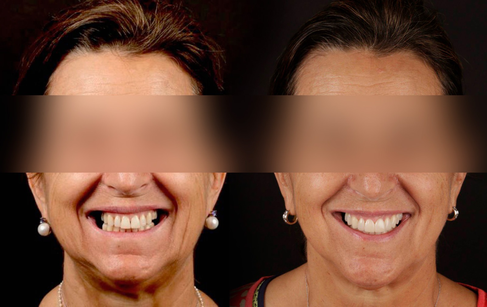 Fotografías de antes y después, de paciente que ha recibido tratamiento de:Orthodontics, Implants, and Veneers