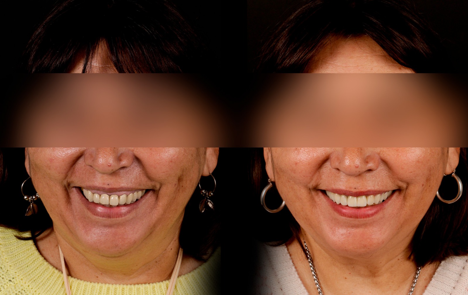 Fotografías de antes y después, de paciente que ha recibido tratamiento de:Periodontics + Veneers